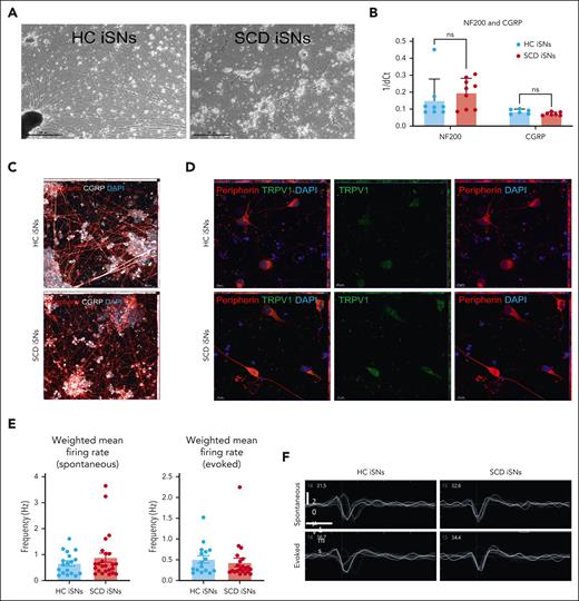 SCD iPSCs and age- and race-matched iPSCs HCs differentiated into sensory neurons (iSNs) express canonical markers and exhibit function indicative of mature human nociceptors. HC and SCD iSNs: brightfield images at original magnification ×4 (scale bar, 500 μm) express transcripts specific for mature sensory neurons (A); NF200 and calcitonin gene-related peptide (CGRP) as analyzed via qRT-PCR (B). Immunocytochemistry (ICC) shows robust protein expression of peripherin (red), CGRP (white), and TRPV1 (green) in both HC and SCD iSNs at original magnification ×20 (scale bar, 50 μm) (C) and original magnification ×63 (scale bar, 10 μm) (D). Images are maximum intensity projections (MIPs) from z-stack series taken on a Zeiss confocal microscope. (E) Spontaneous (left) and electrically evoked (right) weighted mean firing data (frequency; Hz) from HC and SCD iSNs; n = 2 independent differentiations. (F) Representative extracellular recorded waveforms of HC and SCD iSNs during spontaneous and electrically evoked recordings.
