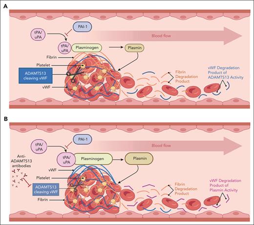 Macrovascular (A) vs microvascular (B) thrombosis. VWF (blue fibrils) is comparatively enriched in the microvascular thrombus, whereas fibrin (orange fibrils) is relatively enriched in the large-vessel thrombus. Products of thrombus degradation are depicted on the right (downstream blood flow) of each image. In the case of large-vessel thrombi, these consist mostly of fibrin degradation products (orange) and ADAMTS13 degradation products of VWF. In the case of microvascular thrombi, degradation products are enriched in plasmin-derived VWF degradation products (cVWF) relative to fibrin degradation products and VWF polypeptides derived from ADAMTS13 cleavage of VWF. Figure courtesy of Paresh Kulkarni.
