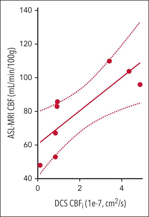 Relationship between DCS and ASL–MRI measures of blood flow. CBF (mL/min per 100 g) measured with ASL-MRI vs CBFi (1 × 10−7 cm2/s) measured with DCS (n = 8 patients). Strong correlation between the 2 measures was observed (R2 = 0.651; P = .015). The solid line denotes the best linear fit to the data, and the dotted lines indicate the 95% CI to this fit. The slope of the line of best fit was 1.00 (95% CI, 0.97-1.03), and the intercept was 60.6 (95% CI, 55.7-65.4). CI, confidence interval.