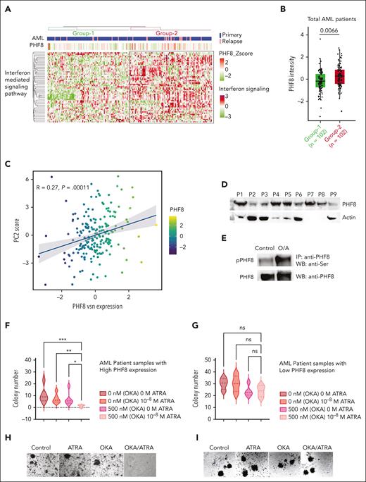 PHF8/IFN-I response protein signature is frequent in patients with AML and provides novel opportunities for future targeted therapies. (A) Unsupervised hierarchical clustering of samples from patients with AML (n = 204 samples) based on proteins participating in GO term IFN-I–mediated signaling pathway. The clustering identifies 2 major sample groups (group-1 and group-2) as highlighted in the heat map. Annotations at the top of the heat map show patient disease status and PHF8 protein expression. (B) Box plot showing the differential expression of PHF8 in AML samples based on IFN protein expression cluster (group-1 = 102 patient samples vs group-2 = 102 patient samples). Two sample t test, permutation-based FDR <0.05 represented as significant. (C) Dot plot for PHF8 expression vs PC2 scores of 204 samples from patients with AML (primary, n = 177; relapsed AML, n = 27) based on the IFN-I signature subproteome. (D) Immunoblot analysis of total PHF8 levels of 9 samples (P1-P9) from patients with AML. Actin was used as loading control. (E) Immunoprecipitated PHF8 from cells from patients with primary AML expressing high PHF8 levels, untreated (control) or under combinatorial treatment with OKA/ATRA (O/A), and immunoblotted for phospho-Ser (upper panel) as well as for total PHF8 protein after membrane stripping (lower panel). (F) Violin plot depicting total numbers of colonies of 5 samples from patients with primary AML with high expression of PHF8 (n = 5). Significance was tested using the Tukey multiple comparison test (2-way ANOVA, ∗P < .02; ∗∗P < .008; ∗∗∗P < .0002). (G) Samples from patients with AML with low expression of PHF8 (n = 4), treated with the indicated concentrations of ATRA and OKA (OKA 20 minutes incubation). Tukey multiple comparison test, ns. (H-I) Colony morphology of primary human AML cells expressing high (H) or low (I) PHF8 levels. Cells were treated with ATRA (10–8 M) or/and OKA (500 nM, 20 minutes incubation). IP, Immunoprecipitation; WB, western blot.