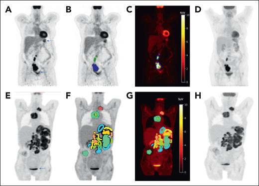 Baseline MTV estimates from whole-body FDG PET images. Single-slice coronal FDG PET images (A,E) demonstrating hypermetabolic uptake in the original image data sets. (A-D) Hypermetabolic FDG uptake in a limited number of lesions in the abdomen and pelvis with an estimated total whole-body MTV of 231.9 mL. (E-H) Hypermetabolic FDG uptake in soft-tissue and nodal lesions in the chest and abdomen with an estimated total whole-body MTV of 1921.7 mL. The segmented lesions containing the individual lesion masks (colored regions in panels B,F) are shown. Within each of these segmented lesions, masks of the FDG PET voxels with SUV values 41% to 100% of SUVmax are delineated on the parametric maps (C,G). The total whole-body MTV is then calculated from the sum of delineated voxels. The arrows represent normal physiologic activity in the bladder (A,E) and gastrointestinal tract (A). Panels D,H are maximum intensity projection images that represent the extent of disease on the whole-body FDG PET.