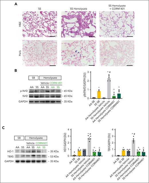 CORM-401 prevents hemolysate-induced lung damage and counteracts pulmonary inflammatory vasculopathy in humanized SCD (SS) mice. (A) Representative micro picture of hematoxylin and eosin–stained sections and Perls-stained sections of the lung at 200× magnification from SCD (SS) mice exposed to sterile buffer (SB) or hemolysate (AA hemolysate in AA recipient and SS hemolysate in SS recipient, respectively) and treated with either vehicle or CORM-401 (scale bar: 50 mm) (see also Table 3). (B) Western blot analysis with specific antibodies against phosphorylated (p)Nrf2 and Nrf2 in the lung from AA and SS mice infused with SB or hemolysate and treated with either vehicle or CORM-401. Glyceraldehyde-3-phosphate dehydrogenase (GAPDH) is used as protein loading control. One representative gel from 5 with similar results is shown. Densitometric analysis of immunoblots (DU: densitometric unit) is shown on the right. Data represent mean ± SEM (n = 5); ^P < .05 compared with vehicle-treated animals; ∗P < .05 compared with AA SB-treated animals; P < .05 compared with SS SB-treated animals by 1-way analysis of variance (ANOVA). (C) Western blot analysis with specific antibodies against HO-1 and TBXS in the lung from AA and SS mice infused with SB or hemolysate and treated with either vehicle or CORM-401. GAPDH is used as protein loading control. One representative gel from 5 with similar results is shown. Densitometric analysis of immunoblots is shown in the lower panel. Data represent mean ± SEM (n = 5); ^P < .05 compared with vehicle-treated animals; ∗P < .05 compared with AA mice treated with SB; #P < .05 compared with SS mice treated with SB by the 1-way ANOVA.