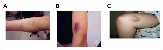 Cutaneous manifestations of thrombocytopenia including petechiae, purpura, and ecchymoses. (A) Petechiae: flat, red, pinpoint lesions often found in groups in dependent areas. (B) Purpura: purple discoloration caused by confluent petechiae in either the skin (dry) or mucosa (wet). (C) Ecchymoses: nontender areas of bleeding into the skin with extravasated blood and breakdown of heme pigments causing red, purple, green, and yellow coloration. These images were originally published in the American Society of Hematology Image Bank. Panel A was adapted from Peter Maslak, Petechiae-1, 2008; image 00003689. Panel B was adapted from John Lazarchick, Idiopathic Thrombocytopenic Purpura-1, 2011; image 00001367. Panel C was adapted from Peter Maslak, Ecchymoses-2, 2011; image 00003688.