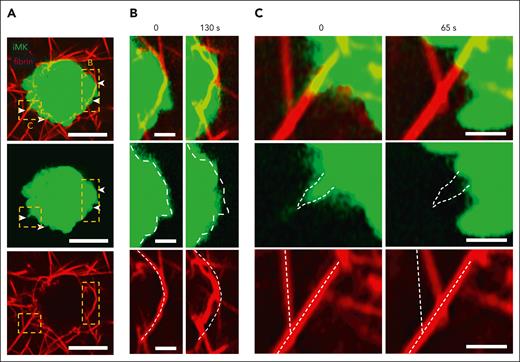 Time-lapse confocal microscopy of a live thrombin-stimulated iMK reveals bending and displacement of fibrin fibers caused by the contracting plasma membrane protrusions. (A) A representative image of a thrombin-stimulated iMK (1 of 11 individual iMKs analyzed) embedded into the fibrin network of a contracting plasma clot. Arrows indicate 2 blebs and a filopodium attached to and pulling on the fibrin fibers. Scale bars, 10 μm. (Top panel) combined fibrin and iMK images; (middle panel) iMK only; (bottom panel) fibrin network only. (B-C) Zoomed images of the contracting blebs (B) and a filopodium (C) indicated in panel A at different time points, showing retraction of the plasma membrane that induces bending and displacement of the attached fibrin fibers. White dashed lines indicate the initial profiles of the iMK emerged protrusions (middle panels) or fibrin (bottom panels). Scale bars, 2 μm. See supplemental Video 3 for the full sequence.