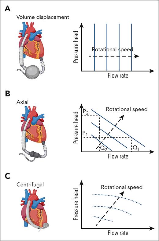 Cartoon of pump attached to the heart relative to representative plots of pressure head (pressure difference between ventricle and greater vessel) and flow rate for various pump speeds. Pressure head is a term used for rotary mechanical pumps that quantitatively defines the pressure increase across the pump, that is, the pressure difference between the aorta and left ventricle for an LVAD. (A) A volume displacement pump: flow rate is driven relatively independently of the pressure head. (B) Axial rotary pumps: for a rotary pump the relationship between pressure head and flow rate depends on the pump style and speed. An axial pump with a pressure head, P1 and a specific rotor speed (separate curves), the flow rate through the pump is Q1. If pressure in the aorta increased, for example, through an increased peripheral vascular resistance, this would lead to an increase in pressure head, P2, leading to a decrease in flow rate for the axial pump, Q2. (C) Centrifugal rotary pumps produce high pressures at lower flow rates when compared to axial pumps, with the pressure head being driven by the rotational speed of the impeller, which may go from 1500 to 3000 rpm for pressure heads of 65 to 285 mmHg.