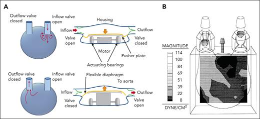 Pulsatile volume displacement pump. (A) Illustration of pulsatile volume displacement pump demonstrating how a typical pump works. Blood flow enters the pump as the flexible diaphragm/membrane is pulled downward in the image. This movement is driven by a pusher plate controlled by a motor. The mechanism varies, depending on the specific pump. With one-way valves at the inlet and outlet, this leads to fluid entering from the ventricle, while the outflow valve remains closed. Flow exits the pump as the pusher plate pushes upward, thereby deflecting the flexible diaphragm, which increases pressure within the pump. The pressure change closes the inflow valve and opens the outflow valve. Blood flow is then driven out of the pump. (B) The shear stress distribution within an example pediatric 15 cubic centimeter volume displacement pump during the ejection of blood from the pump.8 Note that shear stress is pump-specific and depends on the pump volume. It also varies in time and along the depth of the image.