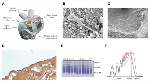 The A-TAH is a hemocompatible device. (A) All A-TAH components, except external batteries, are embodied in a single device, mimicking the normal heart. Electrical-hydraulic rotary pumps activate silicone oil, deploying back and forth hybrid membranes. Endothelial recovery of explanted glutaraldehyde–treated membranes of ventricle in feasibility study. Electron microscopy showed pseudotube formations on this fibrin cap observed in a patient 72 days postimplantation. (B) There was a genuine endothelial covering of the cap in a patient with 270 days of implantation (C). (D) All of the membranes show cells with an endothelial phenotype confirmed by immunohistochemical labeling for VE-cadherin (CD144). (E) Representative VWF multimers contained in plasma samples from patient on HMII, HM3, or A-TAH were detected using the semiautomated Hydragel von Willebrand multimers assay kit (Hydrasis 2 Scan instrumentation, Sébia). Plasma pooled from healthy subjects was examined as standard reference. (F) Multimers densitometry from left low molecular weight multimers (LMWM, peaks 1-5) to the right high molecular weight multimers (HMWM, peaks over 10). Intermediate molecular weight VWF multimers (IMWM) are peaks 6 to 10. VWF multimers from healthy volunteer is indicated by a solid black line, A-TAH samples are in blue, while HMII and HM-3 are respectively in red and orange.