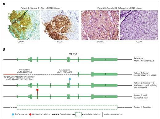 WES and bulk RNA-seq reveal genomic mechanisms of CD20 loss. (A) CD79A and CD20 protein expression determined using IHC on FFPE biopsy sections. The images show staining from a lesion located to the left axilla of patient 3 obtained shortly after the start of CD20 bispec treatment (sample 3.1) and at relapse (sample 3.2), which is representative of the CD20⁻ relapses. (B) Schematic illustration showing CD20 loss was accompanied by genomic alterations, namely an RNA fusion between NHLRC3- NXT1P1 intergenic region and MS4A1 in patient 1 (positions refer to hg19), an intronic T>C mutation leading to cryptic splicing and frameshift in patient 2 (exon5:c.573+2T>C; allelic frequency, 82.10%-100%; tumor content, 80%), a nucleotide deletion with frameshift in patient 3 (exon3:c.212delT:p.M71Rfs∗12; allelic frequency, 16.60%-20.60%; tumor content, 80%), and a biallelic deletion of MS4A1 in patient 6.