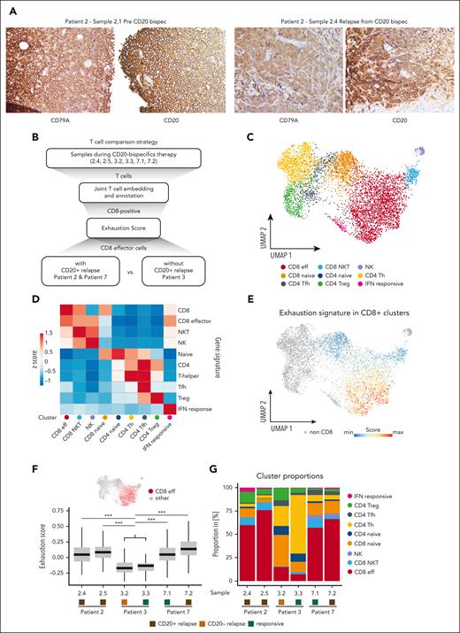Exhausted effector T cells in patients with CD20+ relapse from CD20 bispecs. (A) CD79A and CD20 protein expression determined using IHC on FFPE biopsy sections. The images show staining from patient 2 before CD20 bispec treatment (sample 2.1) and at relapse (sample 2.4), demonstrating relapse with retained CD20. (B) Schematic illustration showing the strategy used to compare scRNA-seq T cells from samples obtained during CD20 bispec treatment, including tumor-free or responsive lesions (n = 2, sample 3.3 and 7.1), CD20⁻ relapse (n = 1, sample 3.2) and CD20+ relapse (n = 3; sample 2.4, 2.5, and 7.2). T cells were combined into a joint embedding, and exhaustion was interrogated based on an established exhaustion gene signature within CD8 subpopulations. The exhaustion scores within CD8 effector T cells were compared between patients who experienced CD20+ relapse (patients 2 and 7) and the patient who did not experience CD20+ relapse (patient 3). (C) Joint UMAP embedding of 6381 T cells from 6 samples. T cells are color-coded based on identified subpopulation. (D) Heat map showing T-cell subset and state gene signature scores across subpopulations, underlying the subpopulation annotation in panel C. (E) Cells are color-coded based on their exhaustion signature score, which was computed across CD8 subpopulations. The gene list underlying the exhaustion score can be found in supplemental Table 3. (F) Box plot depicting the exhaustion scores within CD8 effector T cells across samples. Statistical significance was assessed using a pairwise, 2-sided Wilcoxon rank-sum test against combined samples 3.2 and 3.3 (∗∗∗P < 2.22 × 10⁻16). Center line indicates the median, box limits indicate the upper and lower quantiles, and whiskers indicate the 1.5× interquartile range. (G) Bar plot demonstrating proportions of T-cell subpopulations across samples. eff, effector; IFN, interferon; NK, natural killer; NKT, natural killer T cell; Tfh, T follicular helper; Th, T helper; Treg, regulatory T cell; UMAP, uniform manifold approximation and projection.