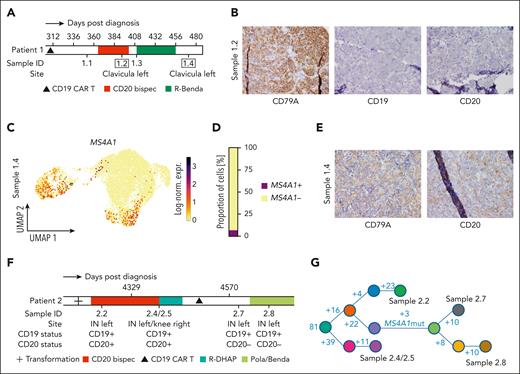 Sequential CD19 and CD20 loss and branching evolution in lymphoma under the pressure of T-cell–redirecting immunotherapy. (A) Schematic timeline of the treatment history and sampling from patient 1 around the 4 sampling time points. Samples 1.2 and 1.4 were both obtained from a lymph node lesion at the left clavicula during CD20 bispecs and 80 days later, respectively. (B) CD79A, CD19, and CD20 protein expression determined using IHC on FFPE biopsy sections of sample 1.2 showing CD19/CD20 double-negative tumor after CD19 CAR T and CD20 bispec treatment, demonstrating sequential antigen loss. (C) Log-normalized MS4A1 expression color-coded and projected on the UMAP representation of sample 1.4 B cells/malignant cells demonstrates the recurrence of MS4A1-positive cells at a single-cell transcriptomic level. (D) Bar plot showing the proportion of MS4A1 expressing cells, determined by at least 1 count of MS4A1. (E) CD79A and CD20 protein expression determined using IHC on FFPE biopsy sections of sample 1.4 with a partially positive CD20 stain, validating CD20 recurrence on protein level. (F) Schematic timeline of the treatment history and sampling of patient 2 around the 4 sampling time points of samples that were subjected to WES (2.2, 2.4 or 2.5, 2.7, and 2.8). Sample ID, site, CD19 status, and CD20 status are indicated. (G) Mock phylogenetic tree constructed from SciClone clusters (indicated by colors) based on WES. The number at the start edge indicates the number of aberrations in the most recent common ancestor, and numbers on branches indicate the amount of acquired mutations. Length of branches does not indicate the extent of differences between subclones. Samples corresponding to subclone branches are indicated; see supplemental Figure 10 for details. IN, inguinal.