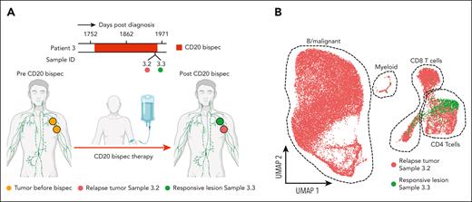 Spatial heterogeneity of CD20 loss. (A) Schematic illustration showing the spatial response heterogeneity in patient 3 to CD20-targeted bispec therapy. (B) UMAP representation of single-cell transcriptomes (25 824 cells) from samples 3.2 and 3.3 colored by sample. Dashed outlines delineate cell type clusters. The schematic was partially created using BioRender.com.