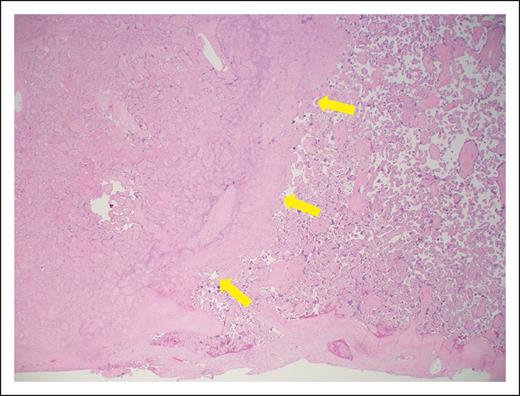 Photomicrograph of placental section (hematoxylin and eosin, low power). The maternal surface is at the bottom. There is villous infarction on the left (yellow arrows), and accelerated villous maturation seen on the right. These findings are indicative of vascular malperfusion, as described in APS pregnancy.10