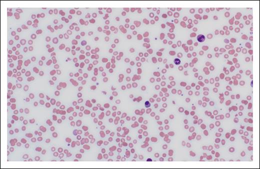 Photomicrograph of peripheral blood smear showing schistocytes.