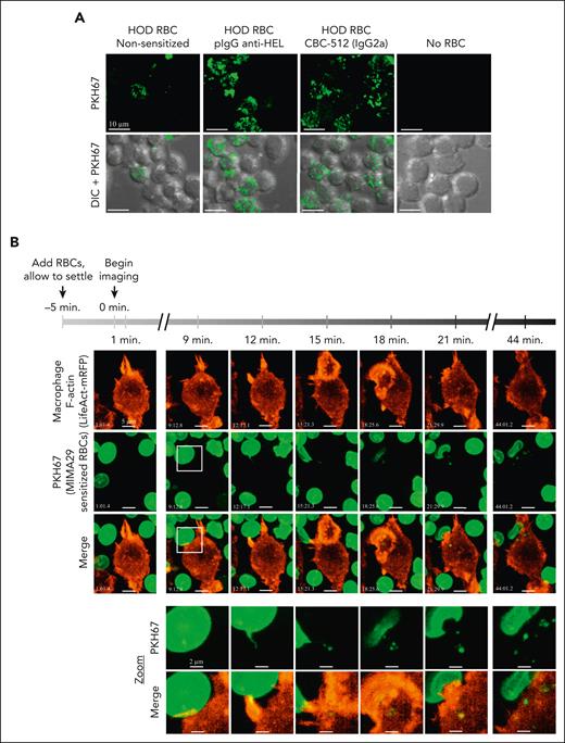 Interaction between macrophages and AMIS-inducing antibody sensitized RBCs triggers erythrocyte membrane nibbling by macrophages in vitro. (A) RAW macrophages were seeded on coverslips for 2 days and maintained in complete RPMI at 37°C and 5% CO2. PKH67+HOD-RBCs were opsonized with pIgG anti–HEL, anti-Duffy CBC-512 IgG2a, or kept nonsensitized (PBS) before incubation with macrophages at 37°C and 5% CO2. After 3 hours, excess RBCs were washed away, and external RBCs lysed followed by fixation and imaging on a Quorum multimodal imaging system (spinning disk confocal) under original magnification ×63 objective oil immersion (numerical aperture 1.47). Scale bar = 10 μm. (B) RAW macrophages were seeded on coverslips and, 1 day later, were transfected with a plasmid expressing the F-actin visualizing protein LifeAct monomeric red fluorescent protein. Twenty-four hours later, transfected macrophages were transferred to a chamlide chamber for confocal microscopy and PKH67+HOD-RBCs sensitized with anti-Duffy MIMA29 were added to the macrophages 5 minutes before imaging to allow the RBCs to reach the bottom. For areas where RBCs and macrophages appear to be in proximity, images were taken every 60 seconds for 45 minutes on a spinning disk confocal as above. Scale bar = 5 μm. The white square at the 9 minutes time point indicates the zoomed area (bottom 2 rows). Zoom: scale bar represents 2 μm. There was a higher apparent level of trogocytosis of RBC membrane fragments by macrophages using the confocal imaging with fixed samples (A) as compared with the LifeAct experiments (B). This is likely explained by the shorter incubation time for the LifeAct experiments (45 minutes vs 3 hours) and phototoxic effects of the repeated imaging for live-cell experiments.
