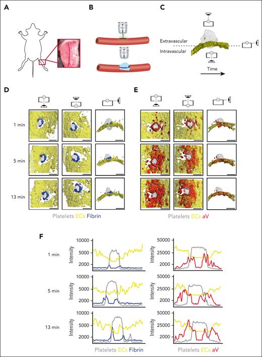 4D imaging model of hemostatic plug formation. (A-C) Experimental setup. (A) Exposed saphenous vein. (B) Laser injury to saphenous vein was induced with Ablate! photoablation system with a 532-nm pulse laser. Accumulation and localization of various hemostatic plug components were recorded using a ZEISS Axio Examiner Z1 microscope with a 20×/1 numerical aperture water immersion objective lens and Slidebook software. (C) Sequential 150-μm Z-stacks of the forming hemostatic plug were acquired with 7.5-μm step size and 4 × 4 binning. Image analysis was performed with ImageTank Software (Visual Data Tools). Image shows surface view of platelets (gray) and ECs (yellow). Icons indicate intravascular, extravascular, and side perspective. (D-E) Visualization of platelets, ECs, fibrin, and PS at sites of vascular injury. Mice with green fluorescent protein (GFP)–expressing platelets (gray) and tdTomato-expressing endothelium (yellow) were infused with AF647-labeled antibody to fibrin (blue) (D) or AF647-labeled aV (red) (E). Images were taken at the indicated time points after laser injury. (F) Overlay of fluorescence intensity histograms for platelets (gray), ECs (yellow), and fibrin (blue) or PS (red) measured along 1 cross-sectional slice of a Z-max projection. Scale bar indicates 50 μm.
