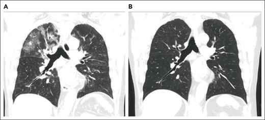 Representative coronal images from a noncontrast chest CT scan. (A) CT scan of the chest, demonstrating a right-sided upper lobe–predominant, peripheral ground-glass opacity at the diagnosis of organizing pneumonia. (B) CT images after 4 months of treatment with prednisone, demonstrating resolution of opacities.