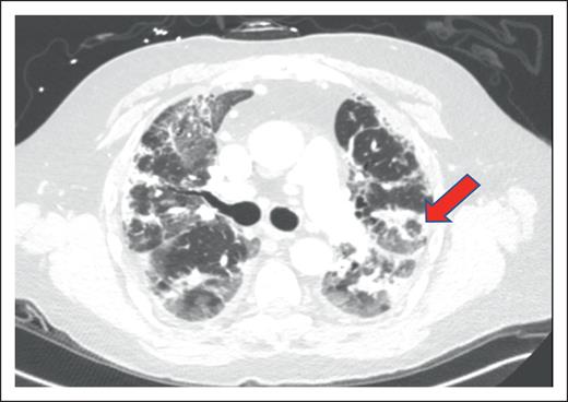 Example of HCT-OP on CT scan of the chest. Noncontrast axial CT image, demonstrating multifocal consolidative and ground-glass pulmonary opacities. The atoll sign (arrowhead) can occasionally be seen and is characterized by central ground-glass opacity surrounded by dense consolidation, representing perilobular involvement, known as the reversed halo sign. Involvement in this case is predominantly peripheral, but HCT-OP can also be peribronchovascular, or occasionally nodular.