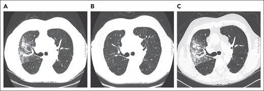 Representative serial axial images of a noncontrast CT scan of the chest for case 2. (A) Axial CT image, showing peribronchovascular consolidations and ground-glass opacities in the right upper lobe. (B) Image showing a complete resolution of radiographic abnormalities after escalating prednisone to 1 mg/kg per day and reinitiation of mycophenolate mofetil. (C) Image showing reappearance of ground-glass opacities with peribronchovascular consolidations in the right upper lobe when the prednisone was tapered to 10 mg/d and positive cytomegalovirus PCR in BAL. Notably, lung findings appear similar to panel A, when his HCT-OP was initially diagnosed.