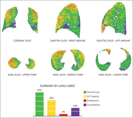 Representative of parametric response mapping analysis for case 4. Dual-phase chest CT scanned at both end inspiration (total lung capacity) and end expiration (residual volume) and analyzed using parametric response mapping, showing 32% functional low-density area representing air trapping (yellow). This was taken at time point 3 on PFT trend (Figure 6A).