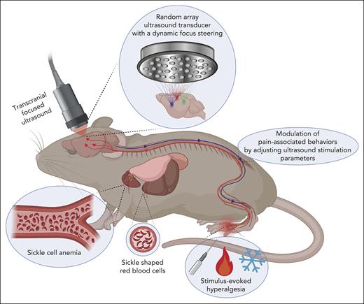 Treating chronic and stimulus-evoked hyperalgesia via tFUS stimulation to specific pain processing brain circuits. The conceptual diagram illustrates the hypothesis of treating chronic and stimulus-evoked hyperalgesia through tFUS stimulation in a humanized mouse model of chronic pain in SCD (HbSS-BERK). The modulation of pain-associated behaviors, such as amelioration or deterioration, is proposed to be achieved by selectively stimulating specific pain-processing brain circuits. This is facilitated using a 128-element highly focused random array ultrasound transducer capable of a dynamic focus steering in HbSS-BERK mice. The diagram captures the idea of targeted neuromodulation to influence pain responses in the context of SCD.