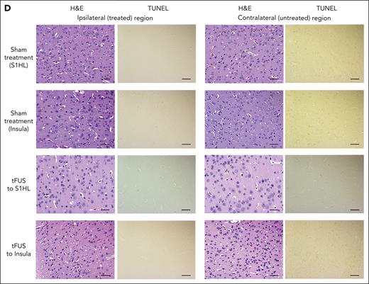 tFUS safety evaluation in female HbSS-BERK mice. (A) The single- and multisession tFUS treatment conditions used in safety study. (B-C) The effect of tFUS on the motor coordination and balance was investigated in rotarod testing. After 60 minutes of single-session tFUS stimulation with a PRF of 40 Hz to S1HL (n = 11) or thalamus (n = 11) and after 60 minutes of multisession tFUS with a PRF of 40 Hz to S1HL (n = 4) or insula (n = 6) for 14 days with 1 hour per day, no significant alteration was observed in the averaged latency to fall compared with prestimulation baseline as well as control groups. In addition, there was no significant difference of control groups from their baseline values using t test with Wilcoxon matched–pairs signed rank test and 1-way ANOVA with Kruskal-Wallis test. (D) Double-blind histological analysis using hematoxylin and eosin (H&E) and TUNEL stains showed that multisession tFUS stimulation to the left S1HL or insula had no adverse impact on tissue structural integrity and nuclear morphology within the treated brain region compared with contralateral brain regions and sham treatment. Scale bars, 50 μm. ns, not significant; TUNEL, terminal deoxynucleotidyl transferase dUTP nick end labeling.