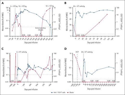 Patient clinical course. (A-D) Marrow blasts as percentage of white blood cells (WBC) (red lines, left y-axis) and absolute count of HA-1 TCR-T (blue lines, right y-axis) are shown for the 4 participants with treatment response. Vertical dashed lines denote HCT or infusion time points. The horizontal dashed line indicates limit of detection for HA-1 TCR-T (0.02 cells per μl). (A) Patient 3 received 2 escalating dose infusions (DL1, DL2), the first at the time of rapidly proliferating T-ALL, resulting in a 6-month remission. Concurrent with falling blood concentrations of TCR-T, he experienced relapse. A third DL infusion given in the context of overwhelming, chemorefractory marrow and extramedullary T-ALL had no effect. (B) Patient 9 had 38% AML in the marrow before receiving a single DL3 infusion, resulting in a complete remission of up to 12 weeks (CRi documented at 3 and 5 weeks, relapse at 12 weeks). (C) Patient 1 entered the trial in an MRD-negative state after serial salvage therapies. He received 1 TCR-T infusion (DL1, CD8 only) with no subsequent pharmacologic maintenance, sustained MRD-negative status through 3 months after infusion, with eventual MRD detection at month 6. He received a second (DL1) and third (DL2, not shown) infusion in the context of MRD, but did not regain MRD-negative CR. (D) Patient 8 had high-risk, TP53+ MDS. She received 1 infusion (DL3) after salvage with hypomethylating therapy and venetoclax and sustained MRD-negative remission following HA-1 TCR-T.