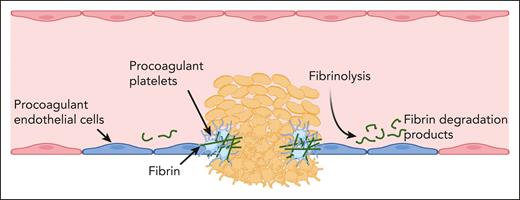 Penetrating vascular injury results in the formation of a platelet plug at the injury site, with phosphatidylserine exposure on both platelets and endothelial cells (blue cells). Platelet procoagulant activity is necessary for fibrin formation at the platelet-endothelial cell interface (green fibers), whereas fibrinolysis prevents fibrin accumulation from spreading across the surface of the endothelium.