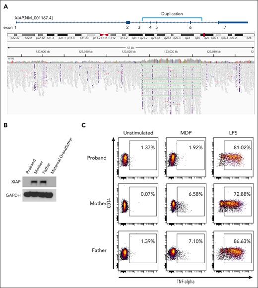 Novel genetic duplication in XIAP leading to absence of protein and function. (A) Genome sequencing read mapping alignment data from proband revealing intragenic multiexonic duplication in the XIAP gene (NM_001167.4). (B) Western blotting analysis of PBMC from the proband, his mother, his father, and maternal grandfather with anti-XIAP and anti-GAPDH (loading control). (C) PBMC from the proband, his mother, and his father were stimulated with media alone (unstimulated), muramyl dipeptide or LPS and intracellular cytokine production was measured using anti-TNFα. Plots are gated on HLA-DR–positive, CD14-positive monocytes. Western blots and flow cytometry plots are representative of 2 independent experiments.
