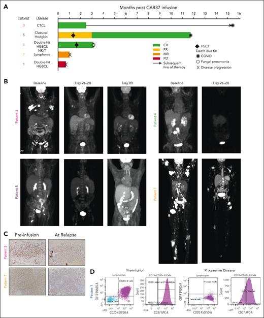 Patient response to CAR-37 T cells. (A) Swimmer plot of patient’s responses to CAR-37 T cells. Two patients received HSCT as a consequence of cytopenia at the time points indicated by the diamonds. Other symbols indicate the cause of death for each patient, as noted. (B) Positron emission tomography (PET) scans of patients with CR, PR, or MR at the indicated time points. (C) Immunohistochemistry for CD37 in lesion biopsies before CAR T-cells infusion (preinfusion) and at the time of relapse by PET scan. Images were taken at 20×. (D) CD19, CD20, and CD37 expression in tumor from patient 1 as measured by flow cytometry performed by the clinical pathology laboratory. The purple dots and histogram represent the aberrant population. CTCL, cutaneous T-cell lymphoma; HGBCL, high-grade B-cell lymphoma; PD, progressive disease; PR, partial response.