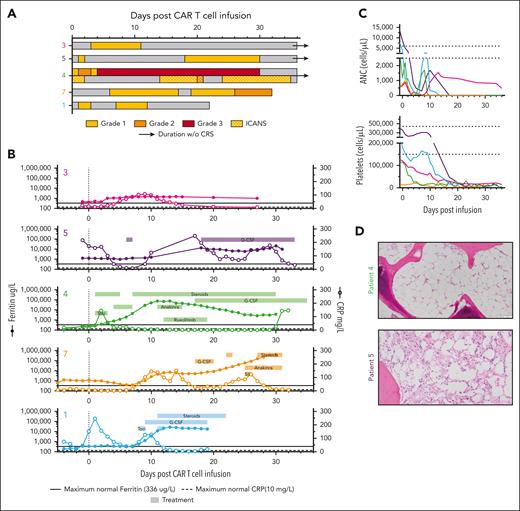 Toxicity in CAR-37 patients correlates with increased serum cytokines. (A) The timing, grade, and duration of CRS (open bars) and ICANS (dotted bars) after CAR-37 T-cell infusion (day 0) are shown. The bar color indicates grade, as noted. Open/white bars indicate duration with no CRS or ICANS symptoms. (B) As part of the diagnostic workup for CRS and ICANS, ferritin (left y-axis, closed symbols) and c-reactive protein (CRP; right y-axis, open symbols) were measured in patient serum over time. The solid black line indicates the maximum normal ferritin level. The dashed black line indicates the maximum normal CRP level. The underlaying horizontal bars indicate the timing and duration of treatment for CRS or ICANS, as noted by the treatment name in the bar. Bars in the same row represent the same treatment. (C) Cell counts per microliter of blood pre- and post-CAR-37 infusion (day 0). Dashed lines indicate the normal range for each cell type. (D) Hematoxylin and eosin staining (20× original magnification) of bone marrow biopsies taken from patients 4 and 5 on day 27 after CAR-37 T-cell infusion. ANC, absolute neutrophil count; G-CSF, granulocyte colony-stimulating factor; Sil, siltuximab; Toci, tocilizumab; WBC, white blood cell.