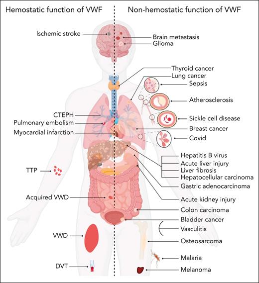 VWF may contribute to disease pathobiology for a variety of both hemostatic and nonhemostatic disorders. Illustration of hemostatic disorders in which VWF has been implicated in playing a direct pathogenic role (left). Illustration of a series of nonhemostatic disorders in which putative pathogenic roles for VWF have been proposed (right). Some evidence suggests that VWF may potentially affect other types of diseases which are not included in this figure. CTEPH, chronic thromboembolic pulmonary hypertension; DVT, deep vein thrombosis; TTP, thromboembolic thrombocytopenic purpura.