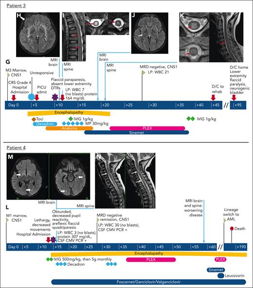 Visual vignettes describing development of paresis in 4 patients with spinal cord abnormalities on neuroimaging. Patient 1: (A) Time line of clinical course. (B) Axial FLAIR images from MRI of the brain showing bilateral, symmetric white matter changes (thick white arrows) with restricted diffusion (diffusion-weighted images not shown). (C) Axial (left) and sagittal (right) T2 images from MRI of the spine showing increased T2 signal in dorsal columns through entire cord (thin red arrows), without enhancement (enhanced images not shown). Patient 2: (D) Time line of clinical course. (E) Axial FLAIR images from MRI of the brain showing changes in the subcortical, deep, and periventricular cerebral white matter (thick white arrows). (F) Axial (left) and sagittal (right) T2 images from MRI of the spine showing increased T2 signal in dorsal columns through entire cord (thin red arrows), without enhancement (enhanced images not shown). Patient 3: (G) Time line of clinical course. (H) Axial FLAIR images from MRI of the brain showing symmetric foci of T2 hyperintensity involving supratentorial white matter (thick white arrow) and brainstem. (I) Axial (left) and sagittal (right) T2 images from MRI of the spine showing diffuse hyperintensity throughout the entire cord, from the brainstem to the conus (thin red arrows), without enhancement (gadolinium-enhanced images not shown). (J) Axial FLAIR images from MRI of the brain showing interval reduction in T2 signal abnormalities from prior study (thin white arrow). (K) Axial (left) and sagittal (right) T2 images from MRI of the spine showing interval progression of mildly expansile T2 hyperintense signal involving most of the spinal cord. Patient 4: (L) Time line of clinical course. (M) Axial FLAIR images from MRI of the brain showing nonspecific nonenhancing white matter T2/FLAIR hyperintensities (thick white arrows). (N) Sagittal T2 image from MRI of the spine showing extensive, patchy, nonenhancing multifocal T2 lesions, some of which were expansile (thin white arrows; contrast images not shown). D/C, discharge; DTR, deep tendon reflex; IVIG, intravenous immunoglobulin; PICU, pediatric intensive care unit; rehab, rehabilitation; WBC, white blood cell.