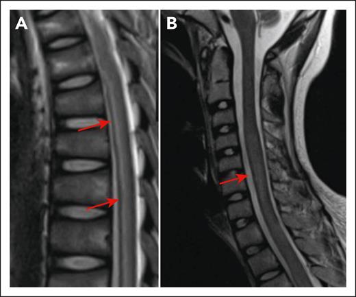 Myelitis following CD19 CAR T cells. (A) Longitudinally extensive T2 hyperintensity in the spinal cord of a 13-year-old presenting with bilateral leg weakness in the setting of CRS and ICANS (day 10 after CD19 CAR T-cell infusion). Arrows show areas of hyperintensity. (B) Increased expansion of the spinal cord T2 signal on day 21 after CAR T. The arrow shows increased expansion of the spinal cord. The figure has been adapted from Figure 1I,K in the article by Diorio et al that begins on page 1387.