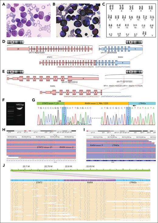Morphological and genetic investigation of the index RARA-aAPL case. (A) Wright staining of BM smear. (B) Myeloperoxidase chemical staining of BM smear. (C) Karyotype 46,XX,inv(17)(p12q21) of BM sample. (D-E) Schematic diagram of the STAT3 exon 21::RARA exon 3 (D) and RARA exon 9@c.1225::LTR40a (E) splices, reported by Arriba version 2.0.1 software with NGS WTS data. (F-G) Electrophoresis result of the RT-PCR product (F), a diagram indicating primer locations (G, upper), and the Sanger sequencing results (G, lower) of the STAT3::RARA::LTR40a tripartite fusion transcript. The bottom peaks in forward Sanger sequencing are due to the minor STAT3 exon 20::RARA exon 3 splice. (H-I) STAT3 intron 21::RARA intron 2 (H) and RARA exon 9::LTR40a (I) splices at the genomic level, as revealed by NGS WGS visualized using the IGV version 2.3.92. (J) Abundant STAT3::RARA::LTR40a tandem genomic splicing fragments captured through optical genome mapping analysis. The human GRCh37 annotation reference was used to annotate gene coordinates on chromosome 17.