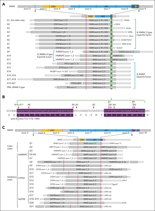 Structural diagram of RARA and RARG fusions. (A) Structural diagram of tripartite and bipartite RARA fusions in each RARA-aAPL case. A∗, unique patient number. (B) Red arrows indicate RARA 3′ splicing sites of each case. The purple background highlights the H11 (left) and H12 (right) coding regions. (C) Structure diagram of tripartite RARG fusion transcripts in each RARG-aAPL case. G∗, unique patient number. The 3′ end of each transcript extends to the first poly(A) signal. Crosshatched bars indicate UTRs; gray-filled bars indicate coding regions; and color-filled bars mark the DBD, LBD, and helices 11 (H11) and 12 (H12). The green background highlights the H11_12 coding region. Dark red dashed vertical lines indicate the splice sites. Bars are displayed proportionally according to their length. Bars with breaks indicate that the length of these segments is not to scale.