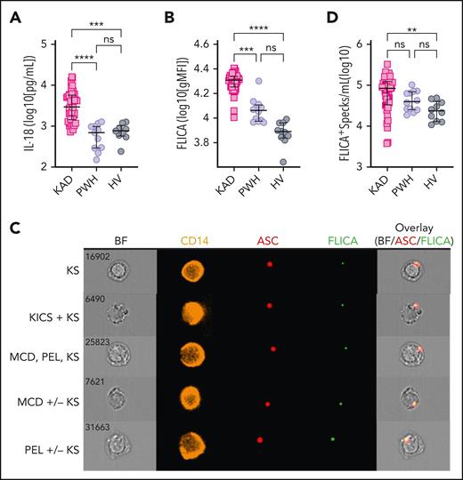 Exacerbated inflammasome activation is found in participants with KAD when compared with PWH and HVs. (A) Plasma levels of IL-18 were compared among participants with KAD (n = 42), PWH (n = 12), and HVs (n = 9). Lines represent median values and interquartile ranges. PBMCs from the same patients and distinct HVs (n = 10) were incubated with the FLICA, stained for monocyte identification and intracellular ASC, and acquired by imaging flow cytometry. (B) gMFI of FLICA within total circulating blood monocytes was assessed. Data are presented as median with interquartile range. (C) Representative images showing respectively CD14, ASC, and FLICA fluorescence followed by a composite image containing brightfield (BF), and the fluorescence of ASC and FLICA merged, were randomly selected from representative samples of the distinct KAD conditions. In these CD14+ cells, FLICA and ASC fluorescence are superimposed. (D) The number of monocytes showing spontaneous FLICA+ ASC-speck formation was quantified after application of Modulation_Morphology (M11,Ch11)_11-ASC feature, followed by Bright Detail Similarity R3_MC_11-ASC_2-FLICA, inside the monocyte gate, by using IDEAS software. Lines represent median values and interquartile ranges. Comparisons were made using the Kruskal-Wallis test followed by the Dunn multiple test. ∗∗P < .01; ∗∗∗P < .001; ∗∗∗∗P < .0001.