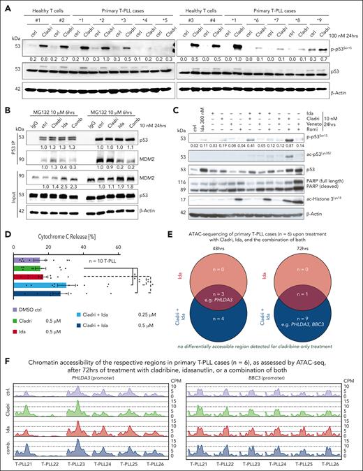 Idasanutlin overcomes the deficiency of T-PLL cells to evoke P53 responses under cytotoxic stress by facilitating the liberation of P53 from its MDM2-bound state. (A) P53Ser15 phosphorylation upon in vitro treatment with cladribine (100 nM; 24 hours) comparing primary T-PLL cells (n = 9 cases) with CD3+ pan–T-cell isolates from 4 age-matched healthy donors. P53 phospho-activation is diminished in 4 of 9 primary T-PLL cases. (B) P53 coimmunoprecipitation was conducted using primary T-PLL cells (n = 2 cases) treated in vitro with idasanutlin and cladribine (each 10 nM). Densitometric quantification involved ratios to the untreated condition based on the expression of the housekeeping protein β-actin. Reduction in the interaction between P53 and MDM2 was observed only in conditions including idasanutlin. (C) P53 phosphorylation/acetylation, PARP cleavage, and Histone 3 acetylation in primary T-PLL cells upon treatment with idasanutlin, cladribine, venetoclax, romidepsin, and respective paired combinations (10 nM; 24 hours; n = 3 cases; exemplary immunoblot shown). Densitometric quantification of phosphorylation was done relative to the untreated condition based on the expression of β-actin. By combining idasanutlin with cladribine, a higher phospho-p53Ser15 induction was achieved than with the single substances. Acetylation of Histone 3 was observed in all romidepsin conditions, but only the combination of cladribine and romidepsin induced detectable p53Lys382 acetylation. Venetoclax + romidepsin did not induce p53Ser15 phosphorylation, but p53 stabilization, and showed the strongest PARP cleavage. (D) Relative cytochrome-c release upon treatment with idasanutlin (red, 0.5 μM), cladribine (green, 0.5 μM), and the combination of both (light-blue, 0.25 μM each; dark blue, 0.5 μM each) in primary T-PLL cells (n = 10 cases). Cytochrome-c release was measured by flow cytometry (mean with SEM; 1-way ANOVA, Bonferroni correction for multiple comparisons, ∗P < .05; ∗∗P < .01; ∗∗∗P<.001). Cytochrome-c release was significantly elevated when cells were treated with the combination of cladribine with idasanutlin. (E-F) ATAC-seq was performed on ex vivo–treated primary T-PLL cells (n = 6 cases; cladribine, idasanutlin, and combination; each 10 nM; 48 and 72 hours). (E) Venn diagram showing differentially accessible regions (FDR < 0.05) upon idasanutlin and the combination treatment after 48 hours (left) and 72 hours (right). Promoter regions of PHLDA3 (48 hours, idasanutlin-only treatment FDR = 0.003; combination treatment FDR = 0.0007; 72 hours, combination treatment FDR = 0.03) and BBC3 (72 hours combination treatment FDR = 0.03) were found to be more accessible preferentially in treated cells. Graphical representation depicting the sliding window sum of counts per million (CPM) for the specified regions of PHLDA3 (left) and BBC3 (right), upon treatment with cladribine, idasanutlin, and their combination for 72 hours (each 10 nM). The ATAC-seq protocol outlined a 500-nucleotide span around the respective peaks within the promoters of PHLDA3 and BBC3, with an additional 400 nucleotides extended to exhibit baseline levels before and after the peak region. Despite notable interindividual variations, both PHLDA3 and BBC3 exhibited significantly enhanced accessibility following treatment with idasanutlin and cladribine. treatment. See supplemental Figure 8 for P53 and MDM2 co-immunoprecipitations in Molt4 and Mac2a T-cell tumor lines, quantification of the immunoblot of panel C, and ATAC-seq data on PHLDA3 accessibility after 48 hours of treatment. Cladri, cladribine; combi, combination; FDR, false discovery rate; Ida, idasanutlin; Romi, romidepsin; Veneto, venetoclax.