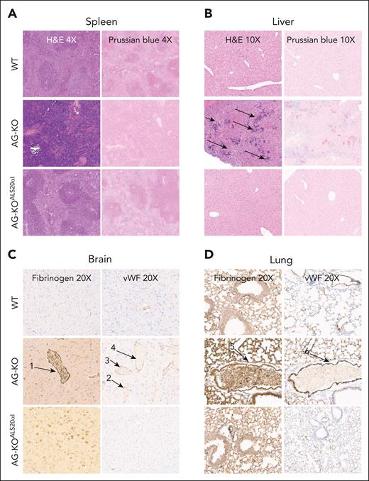 Histology of the spleen and liver, and immunohistochemistry of lung and brain tissue from WT, AG-KO, and AG-KOALS20αIrecipient animals. (A) Representative spleens from WT, AG-KO, and AG-KOALS20αI mouse chimeras stained with hematoxylin and eosin (H&E) and Perls Prussian blue, shown at ×4 original magnification. The spleens of WT animals exhibit sites of high iron staining corresponding to the retention of iron in the macrophages. (B) Representative livers from WT, AG-KO, and AG-KOALS20αI recipient animals stained with H&E and Perls Prussian blue, shown at ×10 original magnification. Arrows indicate sites of extramedullary hematopoiesis. (C) Brain tissues from WT, AG-KO, and AG-KOALS20αI mouse chimeras were stained using antifibrinogen and anti–von Willebrand factor (VWF) immunohistochemistry. Numbered arrows indicate sites of possible vessel occlusion. (D) Lung tissue from WT, AG-KO, and AG-KOALS20αI mouse chimeras was stained using antifibrinogen and anti-VWF immunohistochemistry. Numbered arrows indicate sites of possible vessel occlusion. Arrows 1 and 5 indicate sites of fibrinogen staining, whereas arrows 2-4 and 6 indicate sites of high VWF staining.