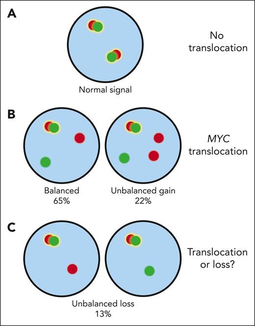 MYC FISH patterns. Cells without a translocation exhibit 2 fusion signals indicative of 2 intact MYC loci (A). In MYC translocated cells, one of the fusion signals is typically split into separate red (centromeric) and green (telomeric) signals. The break-apart can also be accompanied by a gain of the red or green probe (B). So far, there has been uncertainty about the interpretation of unbalanced FISH patterns with loss of either the green or red probe (C). The current study by Collinge et al provides evidence that such alterations reflect genuine rearrangements rather than deletions of the MYC locus.