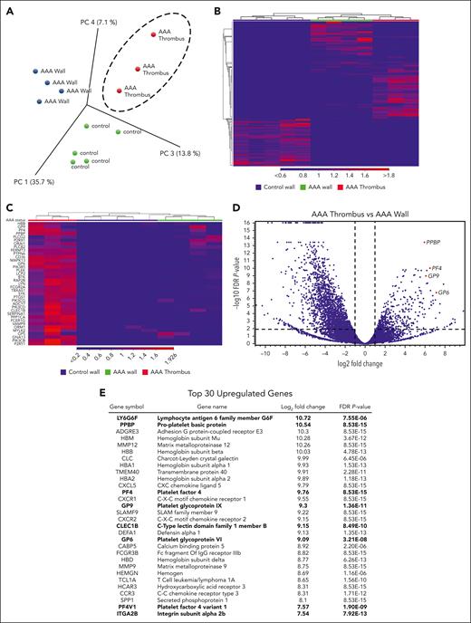 Platelet-associated gene expression is enriched in human AAA thrombi. RNA recovered from age-matched control aortic wall (n = 5), AAA aortic wall (n = 4), and AAA thrombi (n = 3) underwent RNA sequencing (RNA-seq). (A) Representation of principal component analysis of the RNA-seq results from control wall, AAA wall, and AAA thrombus samples. (B) Heat map of differences in gene expression in control wall, AAA wall, and AAA thrombus samples. (C) Heat map of platelet-associated transcripts in AAA thrombus vs AAA and control aortic tissue. (D) Volcano plot showing total fold change and P value of significant AAA thrombus genes vs AAA wall, with highlighted platelet-associated genes (red dots). (E) A list of the top 30 significantly enriched genes in AAA thrombus vs AAA wall; platelet-associated genes are bolded. PC, principal component (analysis); PF4, platelet factor 4.