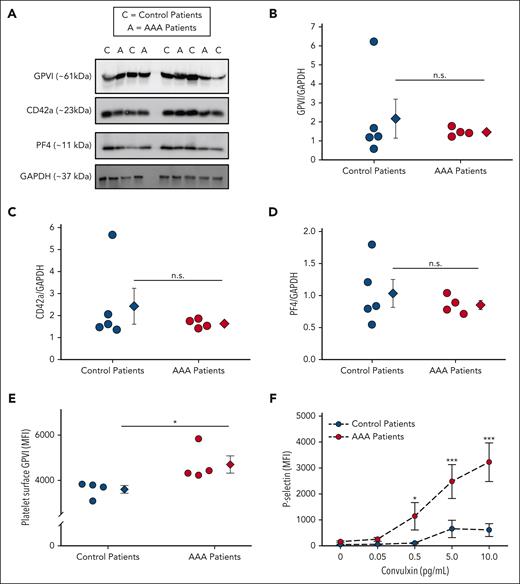 The thrombotic platelet receptor GPVI is more active in human patients with AAA. Platelets from control patients (n = 5) and patients with AAA (n = 4) were analyzed for the platelet receptor GPVI. Platelet GPVI, platelet factor 4 (PF4), and CD42a protein expression was measured by western blot (A) and quantified by densitometry (B-D). GPVI on the platelet surface is increased in patients with AAA vs control (E) as demonstrated by platelet surface flow cytometry (∗P = .039 by Student t test). (F) Platelets isolated from patients with AAA demonstrated significantly more surface P-selectin in response to the GPVI specific agonist convulxin than control as measured by flow cytometry (∗P = .046; ∗∗∗P < .001, patients with AAA vs control patients by 2-way ANOVA). Data are represented as individual points or mean ± standard error of the mean (SEM). MFI, mean fluorescence intensity; n.s, not significant.