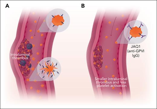 Inhibition of GPVI impairs growth of AAA. (A) Resting platelets expressing GPVI (blue) circulate in the bloodstream (upper insert). Some platelets interact with the intraluminal thrombus and become activated. These platelets shed their GPVI and can express P-selectin (red, lower inset). These platelets can either incorporate into the thrombus and recruit leukocytes (purple) or circulate as partially activated platelets. Plasma levels of soluble GPVI fragments shed from activated platelets serve as a biomarker for fast-growing aneurysms. (B) Anti-GPVI IgG interferes with platelet incorporation into intraluminal thrombi and decreases thrombus size. Red arrow indicates blood flow. Professional illustration by Somersault18:24.