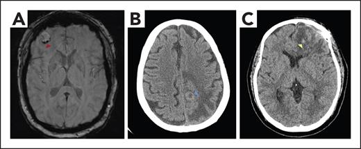 Imaging of patients with brain tumors with or without ICH. (A) MRI brain axial susceptibility weighted image demonstrating a right frontal brain metastasis with mild peripheral hemosiderin deposition (red arrowhead), consistent with chronic hemorrhage. (B) Noncontrast CT brain axial image revealing a peripherally hyperdense lesion (blue arrowhead) with surrounding confluent hypodensity in the left posterior frontal lobe, consistent with a brain metastasis and vasogenic edema. The hyperdense rim represents high cellularity within the tumor. (C) Noncontrast CT brain axial image showing left frontal postoperative change status after glioblastoma resection, with hypodense vasogenic edema and scattered foci of hyperdensity (yellow arrowhead) consistent with subacute blood products.