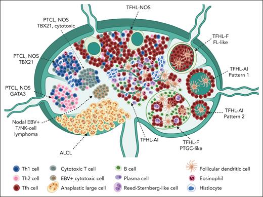 Histological presentation of primary nodal T- and NK-cell lymphomas. Anaplastic large cell lymphomas (ALCLs), ALK+ or ALK−, tend to invade the peripheral sinuses and produce cohesive sheet-like infiltrates in the lymph node. Peripheral T-cell lymphoma, NOS (PTCL, NOS) is not associated with a characteristic pattern of growth, and can to a variable extent replace the normal lymphoid tissue. Subtypes of PTCL, NOS are composed of mostly CD4+ or CD8+ lymphoid cells with a phenotype resembling that of Th1 or Th2 cells, or of cells expressing cytotoxic molecules. The tumor microenvironment tends to be more abundant in Th1-type PTCL, NOS, and can sometimes comprise abundant epithelioid histiocytes. Primary nodal EBV+ lymphomas derived of cytotoxic T cells, or less commonly NK cells, represent a rare aggressive entity, which is mostly reported in Asians. Lymphomas derived from CD4+ TFH cells (TFHL) represent the most prevalent nodal PTCL with a variety of histological patterns. The most common form of TFHL is the angioimmunoblastic type (TFHL-AI), which in its usual form is a diffuse microenvironment-rich tumor, comprising a proliferation of arborizing vessels and follicular dendritic cells, and an infiltrate of many reactive large (blastic) and small B cells, plasma cells, histiocytes, and non-neoplastic T cells. Less commonly, the neoplastic cells of TFHL-AI concentrate around reactive or regressive germinal centers (patterns 1 and 2), and these may be more difficult to diagnose because of the association with reactive follicles. In the uncommon follicular type of TFHL (TFHL-F), the neoplastic TFH cells grow in follicles, resembling folliicular lymphoma (FL-like), or in clusters within large B-cell nodules resembling progressively transformed germinal centers, which is an uncommon form of reactive follicular hyperplasia (PTGC-like). The NOS subtype of TFHL, defined by the TFH phenotype of the neoplastic cells, does not contain the complete microenvironment of TFHL-AI, grows diffusely, and may preferentially distribute in the paracortex and between preserved follicles. TFHL, in particular the AI and follicular subtypes, may contain large atypical cells resembling Reed-Sternberg cells, a source of frequent diagnostic difficulties in distinguishing them from classic or nodular lymphocyte predominant Hodgkin lymphoma.