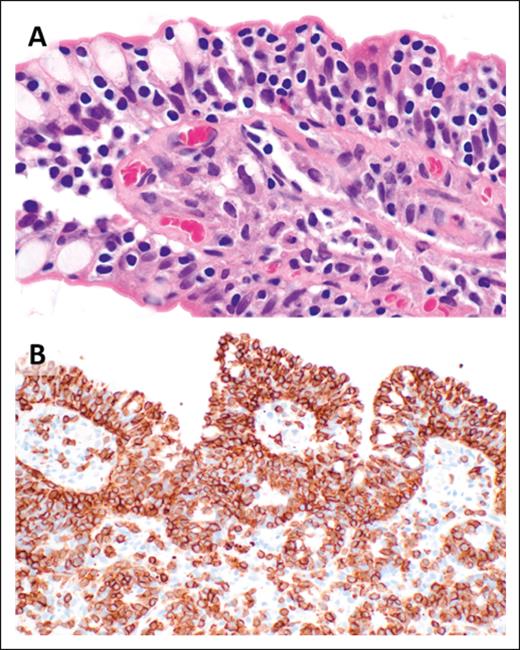 MEITL. (A) Small- to medium-sized lymphoma cells with dense chromatin and pale cytoplasm display marked epitheliotropism (original magnification, ×1000; H&E stain). (B) CD3 immunohistochemistry highlights a dense mucosal infiltrate of lymphoma cells with striking involvement of the surface epithelium (original magnification, ×400).