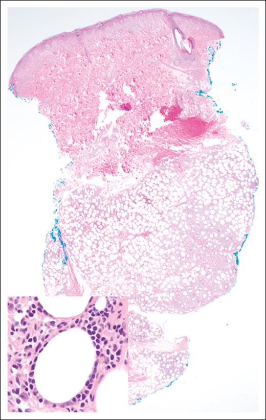 SPTCL. The lobular subcutaneous infiltrate spares the overlying dermis and epidermis (original magnification ×20; H&E stain). Inset: the lymphoma cells display a characteristic rimming pattern around adipocytes (original magnification ×500; H&E stain).