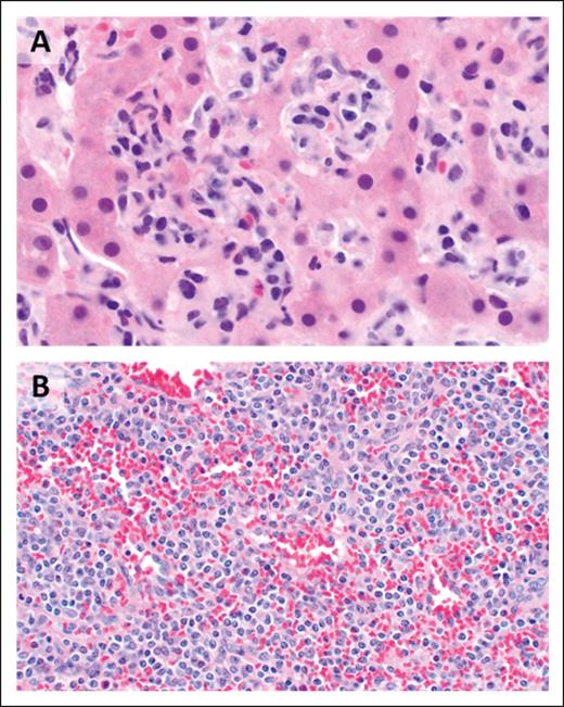 HSTCL. (A) The hepatic sinusoids are filled and expanded by lymphoma cells (original magnification ×1000; H&E stain). (B) The splenic red pulp is extensively infiltrated (original magnification, ×500; H&E stain).