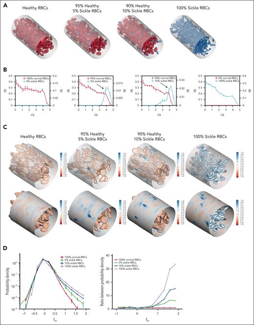 sRBC subpopulations demonstrate increased margination and induce local wall shear stress fluctuations in computational simulations. (A) Angled views of snapshots taken from computational simulations of RBC suspensions composed entirely of hRBCs (left), binary suspensions with a majority of hRBCs and a minority population of sickle RBCs comprising 5% (second) and 10% (third) of the overall suspension, and a suspension composed entirely of sRBCs (right). Each simulation was conducted with a hematocrit of 20%. Because sRBCs have a smaller size than hRBCs, there is a larger number of total RBCs in the 100% sRBC suspension. Binary suspensions were designed to mimic ISCs in individuals with SCD. A CFL can be observed in homogeneous suspensions composed of 100% hRBCs or 100% sRBCs, whereas in binary suspensions, marginated sickle cells are concentrated within the CFL close to channel walls. (B) Steady-state radial hematocrit profiles (Ht) for hRBCs (red) and sRBCs (blue) in RBC suspensions containing 0%, 5%, 10%, and 100% sRBCs, respectively. The x-axis depicts distance from the center of the channel scaled with the radius of a hRBC (scaled radius, r/a), with 0 being the center of the channel and 5 representing the channel walls. In all cases, the hematocrit of the hRBCs as well as sRBCs in the 100% sRBC suspension, drops precipitously close to the wall, corresponding to the CFL. In binary suspensions, sRBCs tend to marginate and travel in higher percentages within the CFL close to channel walls, whereas hRBCs concentrate around the center of the channel. Sickle RBCs in the 100% sRBC suspension did not exhibit the same margination, maintaining the CFL; this can be attributed to the presence of deformable, hRBCs in the binary suspensions, which drive the sRBCs toward the walls. (C) Snapshot of the spatial distribution of additional wall shear stress (τˆw) induced by hRBCs (left), binary sRBC suspensions comprising 5% (second) and 10% (third) sRBCs and 100% sRBCs (right), respectively. Blue regions indicate large fluctuations and are more numerous in the presence of sRBCs. (D) Probability density profile of excess wall shear stress induced by varying fractions of sRBCs (left). The binary suspensions created large fluctuations in wall shear stress in comparison with the hRBC suspension. The ratio between probability densities (right) shows large positive fluctuations in wall shear stress in binary suspensions of 5% and 10% sRBCs.