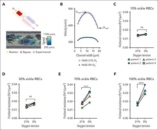 Microfluidic analysis of SCD RBC properties indicate changes in rheological properties in blood flow as the quantity of polymerized RBCs changes for both native and transfused blood. (A) The microfluidic rheology platform consists of a multilayer microfluidic device with a bifurcating blood channel designed to mimic the cross-sectional area of a small arteriole or venule as shown. The device allows for perfusion of blood at a fixed-pressure, isolated control of reduced oxygen tension to the experimental channel, as well as simultaneous measurement of RBC velocity profiles using the Kanade-Lucas-Tomasi algorithm and custom MATLAB scripts. All blood samples were prepared to a hematocrit of 25% in phosphate buffered saline. (B) RBC velocity profiles for 1 blood sample of a patient with SCD subjected to 21% oxygen and 0% oxygen showed a decrease in average velocity while demonstrating decreases in both the wall velocity (Vwall) and the max velocity (Vmax). (C-F) The direct effect of polymerized sRBCs on bulk rheology is determined using an exchange transfusion technique and measuring rheological properties at 0% oxygen and comparing with the 21% oxygen condition immediately before cycling oxygen off. Exchange transfusions of SCD blood samples are prepared ex vivo at ratios of 10%, 30%, 70%, and 100% SCD blood. Rheological analysis shows an increase in the frictional resistance for each condition indicating that the presence of sickled RBCs impedes flow near the channel walls. Statistical analyses used Welch t test; ∗P ≤ .05; ∗∗P ≤ .01; ∗∗∗P ≤ .001; ∗∗∗∗P ≤ .0001. ns, not significant.