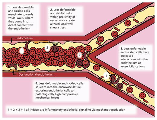 Biophysical alterations of less-deformable and sRBCs directly induce endothelial inflammation via margination and increased RBC-endothelial interactions. Cartoon representation of our new paradigm of SCD vasculopathy, showing that when RBC suspensions are not uniform, such as in SCD, a subpopulation of the smallest and least-deformable sRBCs will tend to enter the CFL and marginate closer to vessel walls. These marginating RBCs not only come into direct contact (ie, RBC-EC collisions) with the endothelium but also create altered local wall shear stress, simply from coming into close proximity to the vessel wall, inducing endothelial inflammation via mechanobiological mechanisms. Furthermore, as these less-deformable and sRBCs flow into smaller areas of more complex geometries, such as at bifurcations, additional brief, collision-like events will occur secondary to their altered flow patterns, causing further exposure to increased mechanical forces. Finally, as sRBCs squeeze into the capillaries, ECs are exposed to pathologically increased compressive mechanical forces, which again induce a proinflammatory phenotype via mechanotransduction.